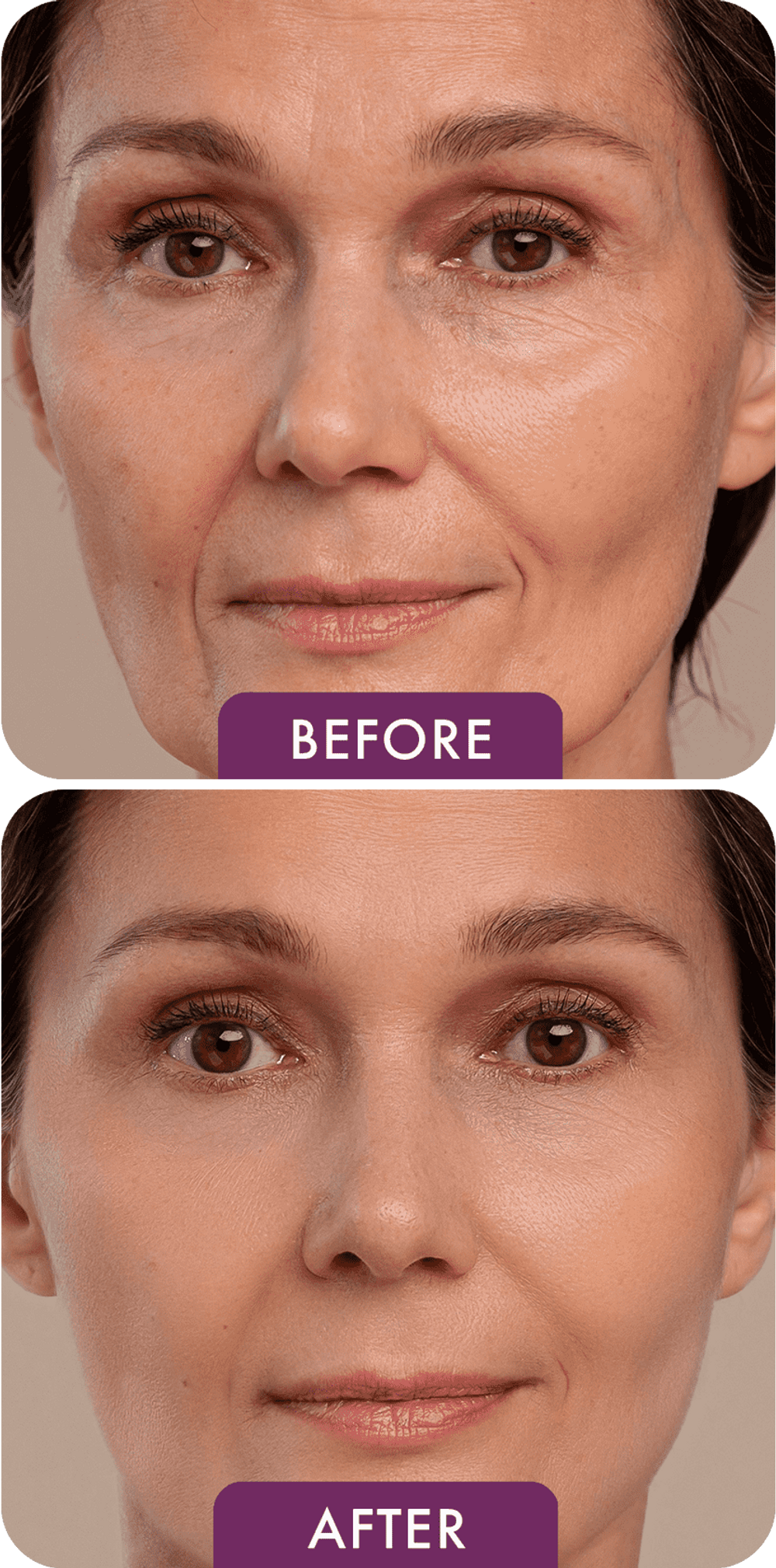 Two photos of the same woman. The upper photo is labeled Before and shows lines around her eyes, forehead and mouth. The lower photo is labeled After and shows smoother, firmer looking skin.