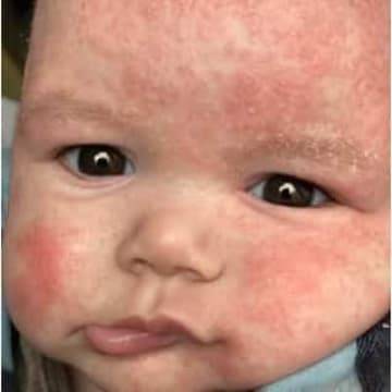 A baby's face with severe eczema and irritated skin
