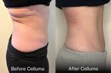 Side photo of woman's midsection who received 6 treatments with Celluma light therapy for body contouring with red light and near infrared light. She lost a half inch of her waist, a half inch of her hips, smoother skin, and relief from lower back pain.