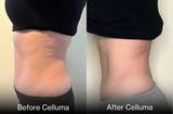 Side view of woman's midsection showing visible waistline reduction with LED light therapy for body contouring with Celluma. Results after six 30-minute treatments.