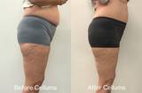 Side profile before & after photos showing a woman's reduction in waistline after using Celluma LED light therapy for body contouring.