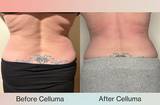 Back photo of woman's midsection who received 6 treatments with Celluma light therapy for body contouring with red light and near infrared light. She lost a half inch of her waist, a half inch of her hips, smoother skin, and relief from lower back pain.