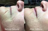 Red light therapy for aging before and after photos. Image shows a side profile of a woman's face with reduced fine lines and wrinkles, reduced inflammation, and improvement in the appearance of the skin. Results after 4 weeks of treatment, 2 times per week.