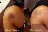 Before and after image of an individual who used Celluma on the Pain mode for a bruise on the knee/leg.