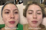 Before and after image of a women who used Celluma to treat acne on the face.