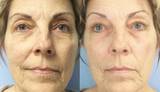 Before and after image of a women who used the Celluma LITE on the Aging mode to reduce fine lines and wrinkles.