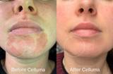 Before and after images of a women's chin showing reduced inflammation and redness.