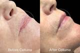 LED red light therapy for aging before and after photos. Photos show a side profile of a woman's face with reduced fine lines and wrinkles along with improved texture of the skin red, near-infrared, and blue light therapy. Protocol was 30 minutes, 3 times per week, for 4 weeks. After photo was taken 8 weeks post treatment.