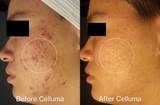 Before Celluma (left side) and After (right side) showing results from an acne patient with significantly reduced acne lesions and redness with red and blue LED light therapy. After photo was taken following 8 weeks of treatment 2 times per week.