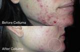 Before and after image of a women who had bad acne on the face but treated it with Celluma Acne mode.