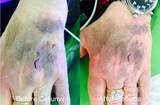 Celluma device used on Pain mode to achieve before and after results on bruised hand.