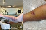 Celluma device used on Pain mode to achieve before and after results on bruised full arm.