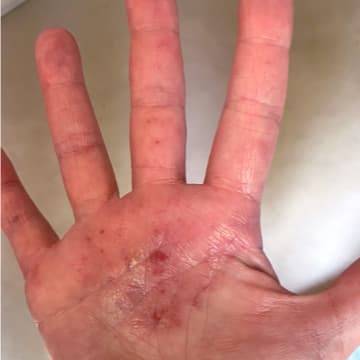 Woman with severe eczema on hand
