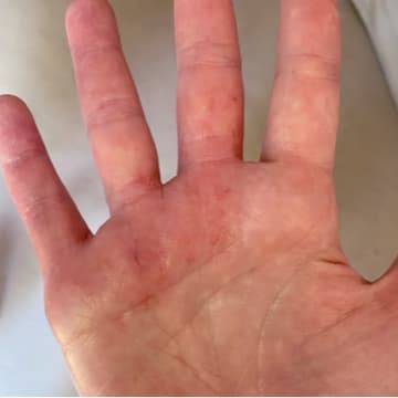 Healed hand free of eczema from using all-natural, vitamin rich goat milk soap