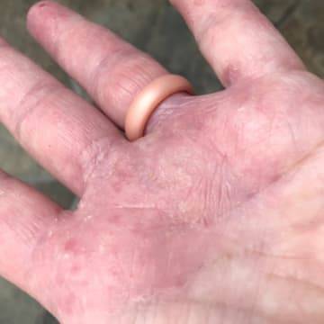 Woman with severe eczema covered palm