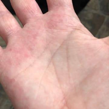 Woman with healed palm free of eczema