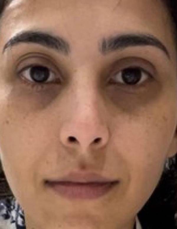 Tribe Skincare Brightening Vitamin C Serum Before and After (2 weeks)