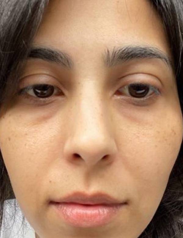 Tribe Skincare Brightening Vitamin C Serum Before and After (2 weeks)