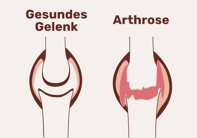 Der Vergleich zwischen einem gesunden Gelenk und Arthrose-Gelenk