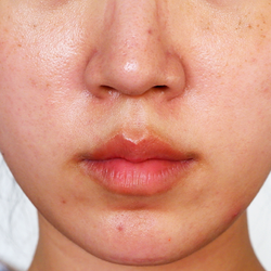 Skin Barrier 101