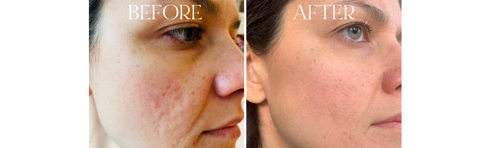 Sofia's Before And Afters Addressing Hyper-pigmentation And Acne Scars