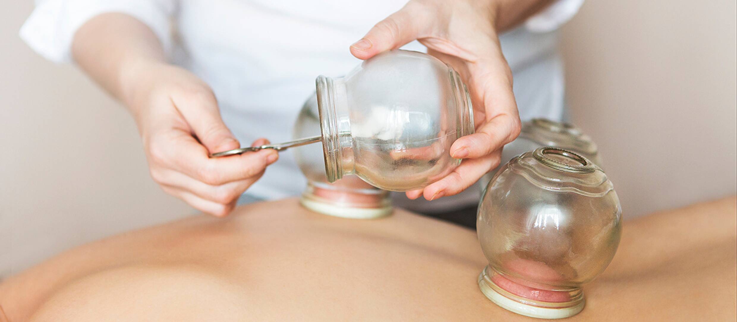 Cupping Therapist placing glass cups on patient