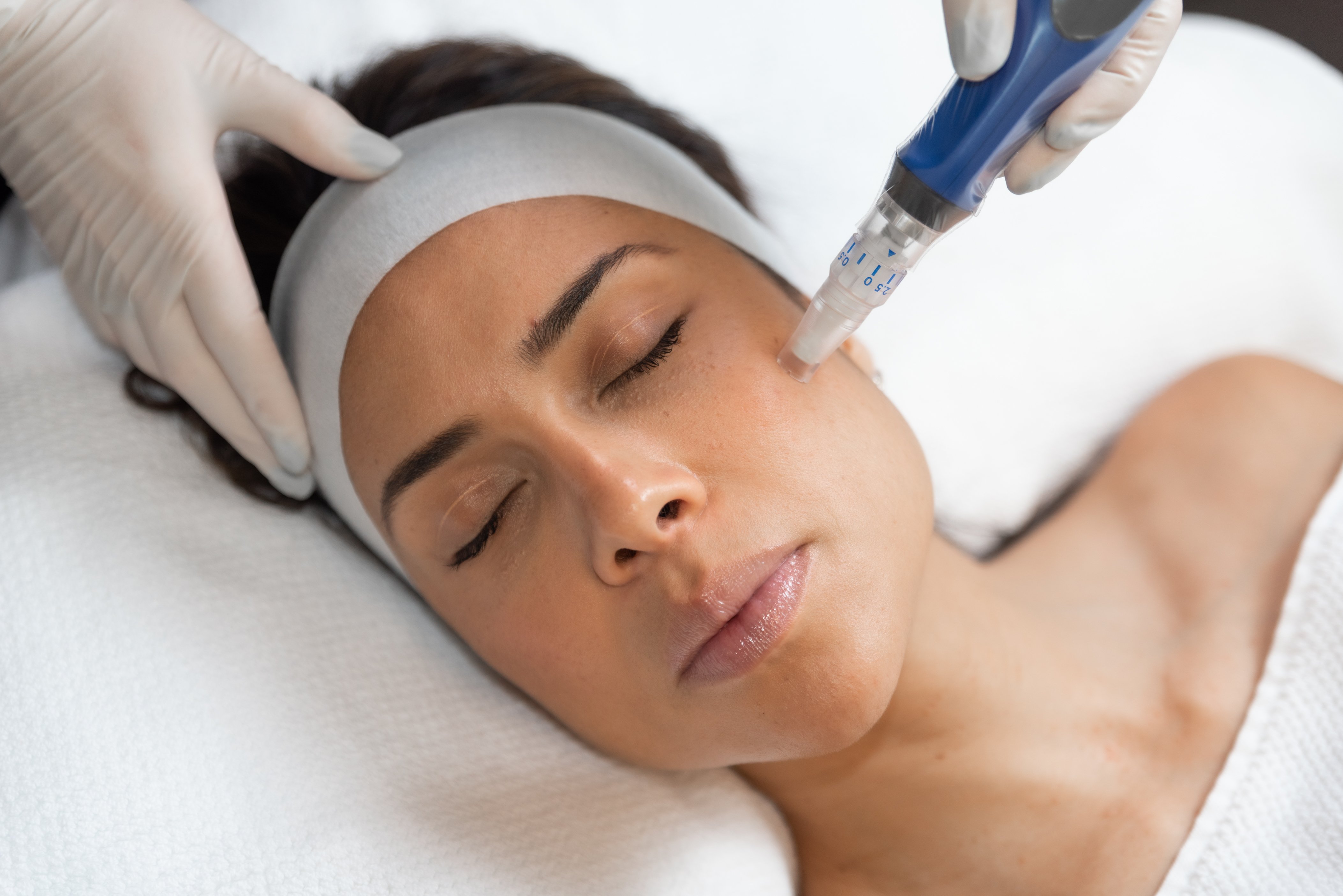 SkinPen Micro Needling The Clinic Bondi - Main Image