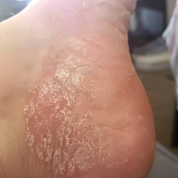 Closeup of a woman's foot showing symptoms of eczema like peeling skin