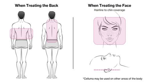 The Celluma PRO has a treatment areas for the back and face. 