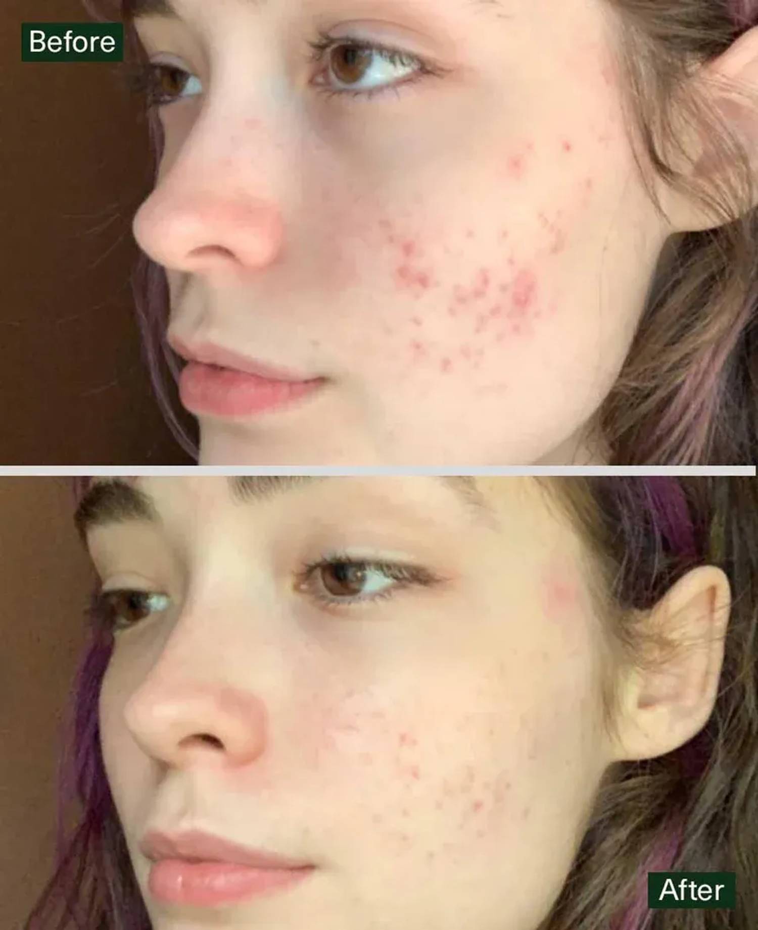Acne Fighting Phage Serum before and after 