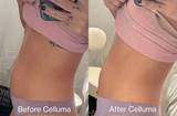 Before (left) and after (right) images of woman's mid section after one Celluma CONTOUR light therapy treatment showing visible reduction in the circumference in the waistline. 