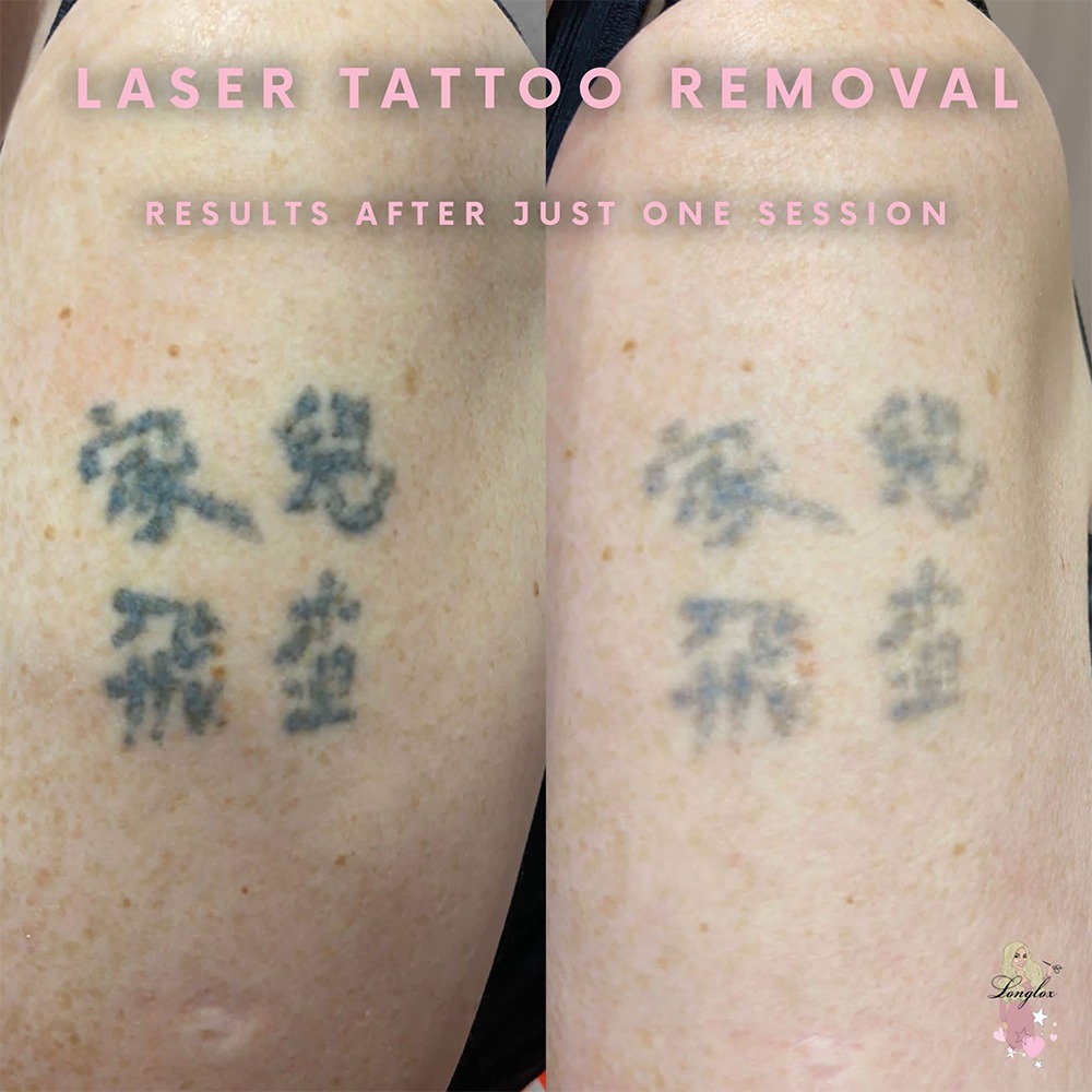 Laser Tattoo Removal Course | Enrol Now — Bravura Education