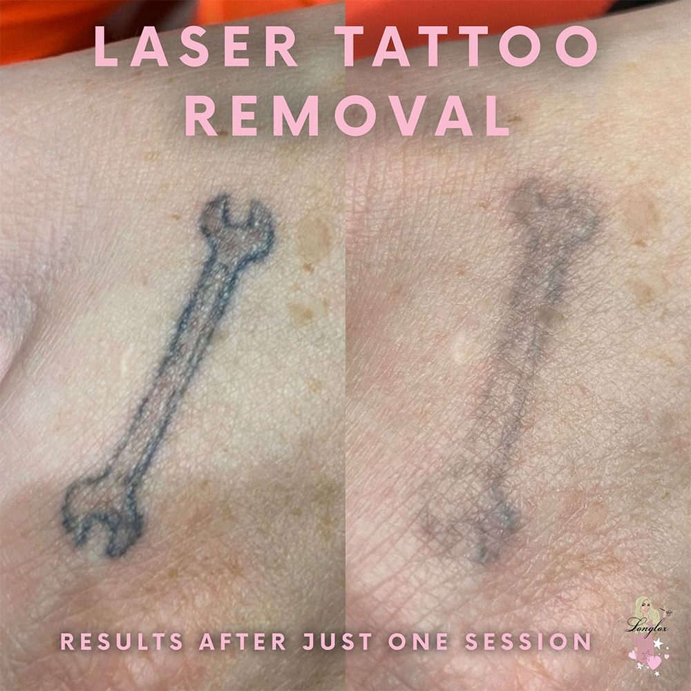 Laser Tattoo Removal Medical Spa | San Diego, CA | CLDerm
