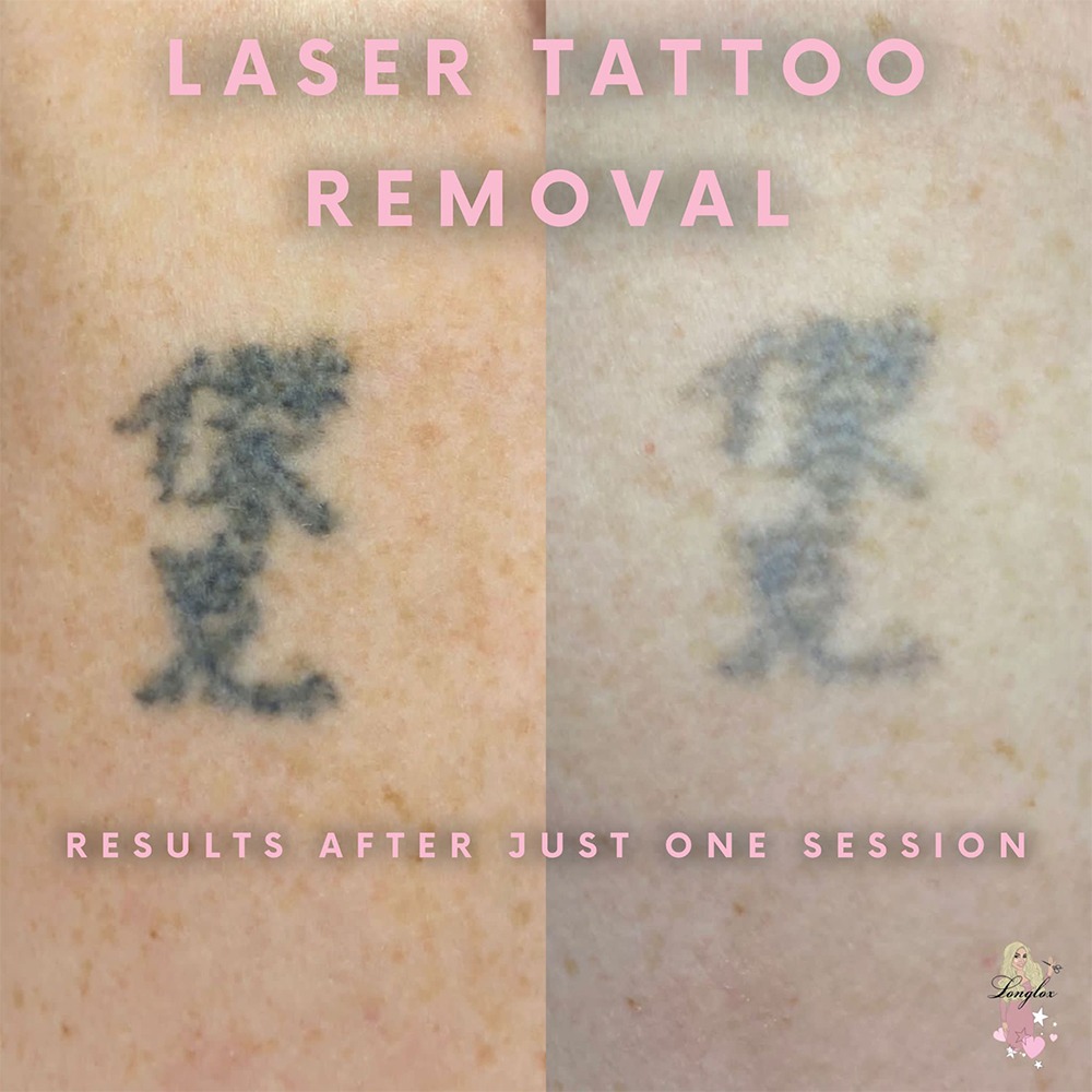 Laser tattoo removal by Natalie | Newcastle upon Tyne