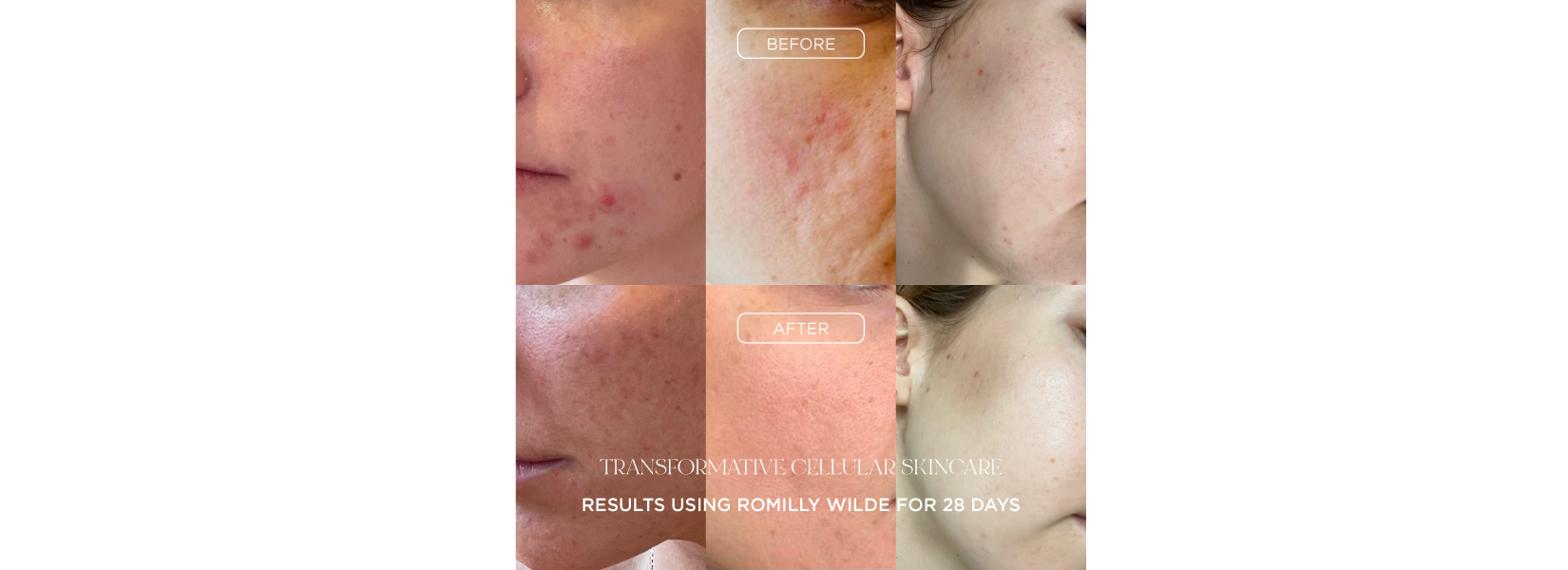 Real Before And After Results With Romilly Wilde Skincare