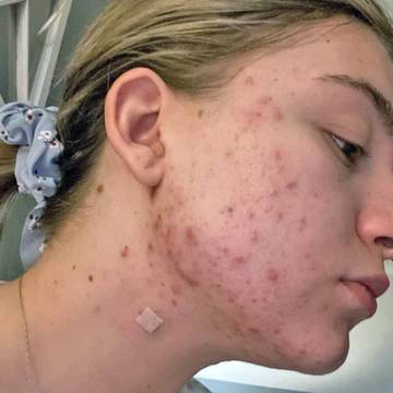 Woman's Cheek Showing Severe Signs of Acne
