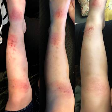 Toddler with severe eczema on both legs