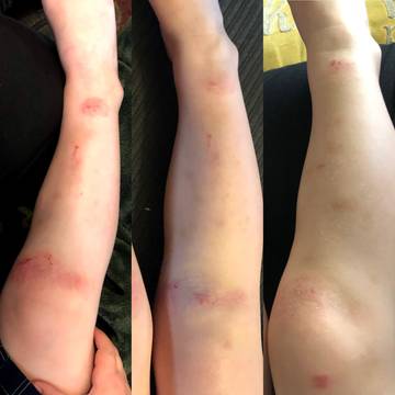 Toddler's legs are healed from severe eczema after using all natural goat milk soap and lotion