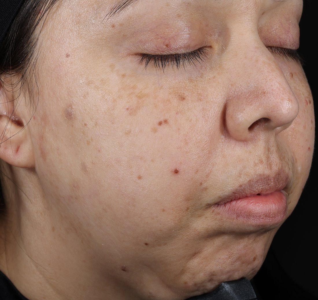 Close-up of facial skin eight hours after applying Obagi SoMD Moisture-Restore, showing hydrated texture.