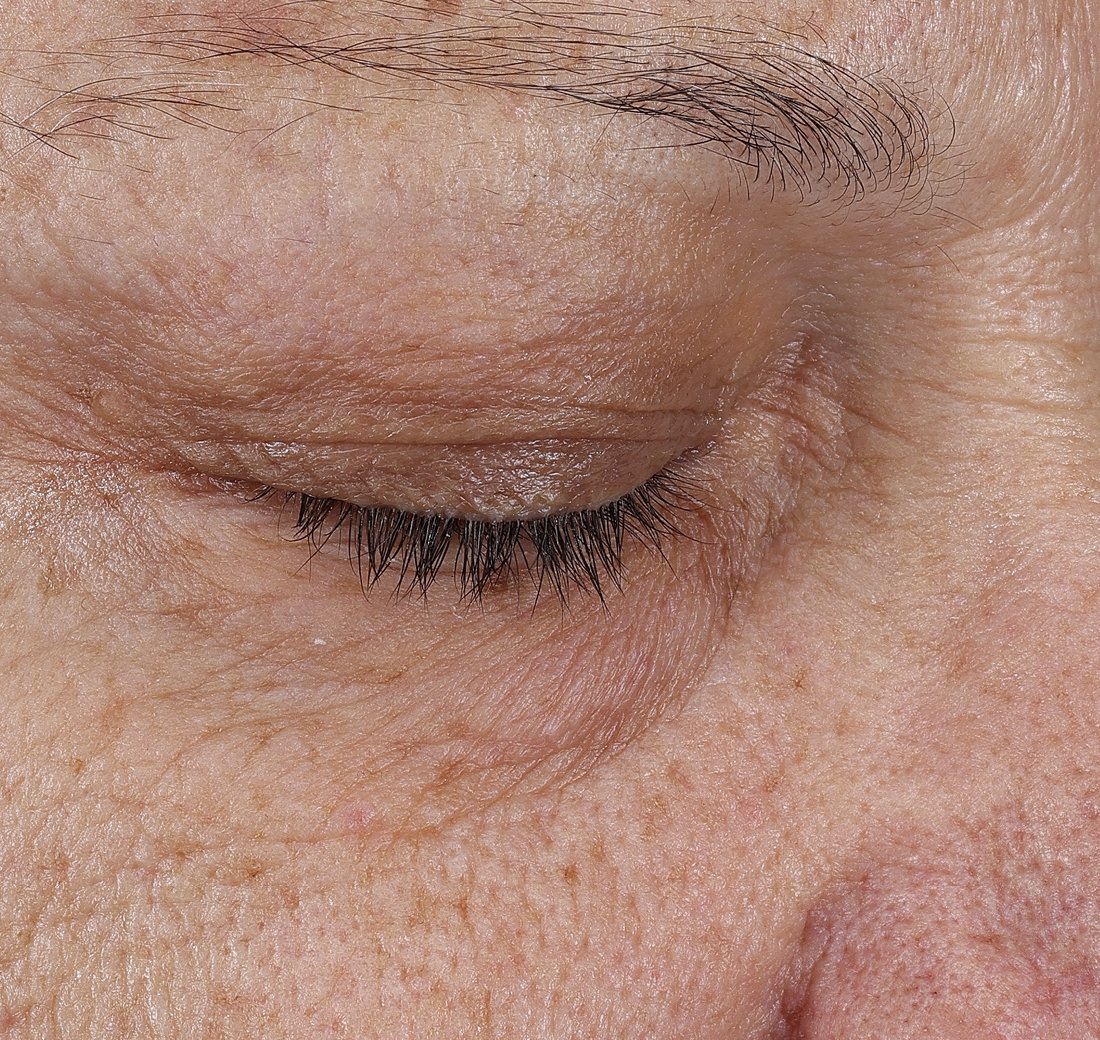 Close-up of facial skin eight hours after using Obagi SoMD Moisture-Restore, appearing more hydrated.