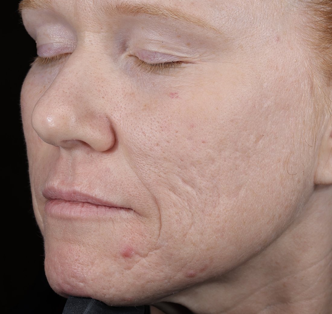 Cropped close-up of facial skin eight hours after using Obagi SoMD Moisture-Restore, showing improved hydration.
