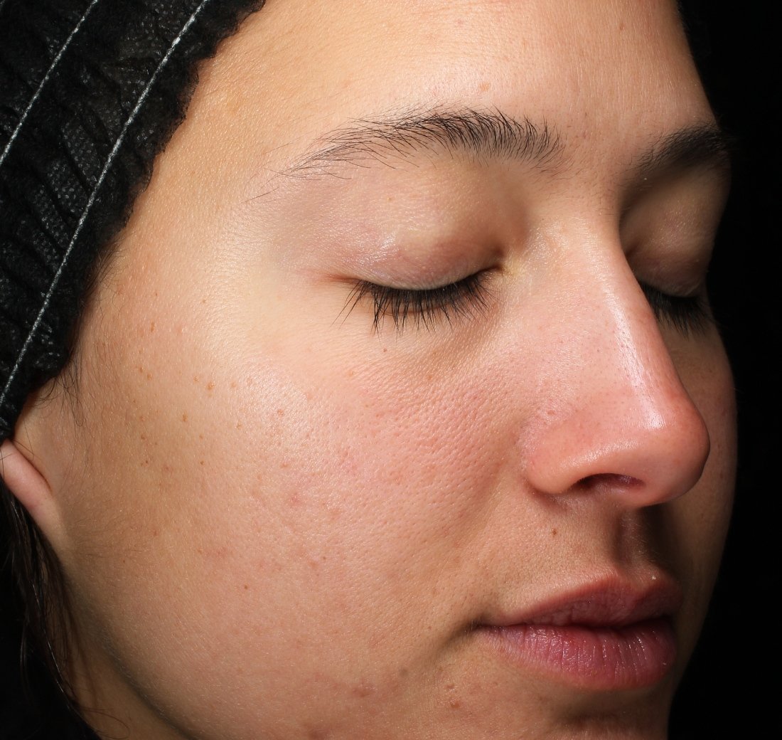 Baseline close-up of facial skin before applying Obagi Retinol + PHA product.
