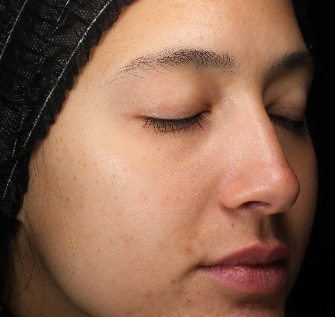 Close-up of skin after four weeks of Obagi Retinol + PHA product use.