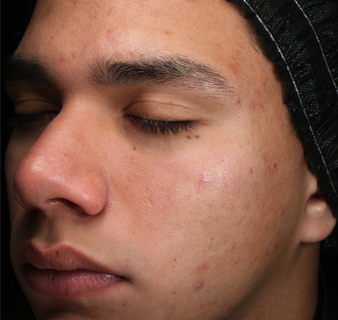 Baseline close-up of facial skin before using Obagi Retinol + PHA.
