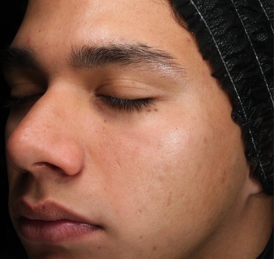 Close-up of facial skin after four weeks of using Obagi Retinol + PHA.