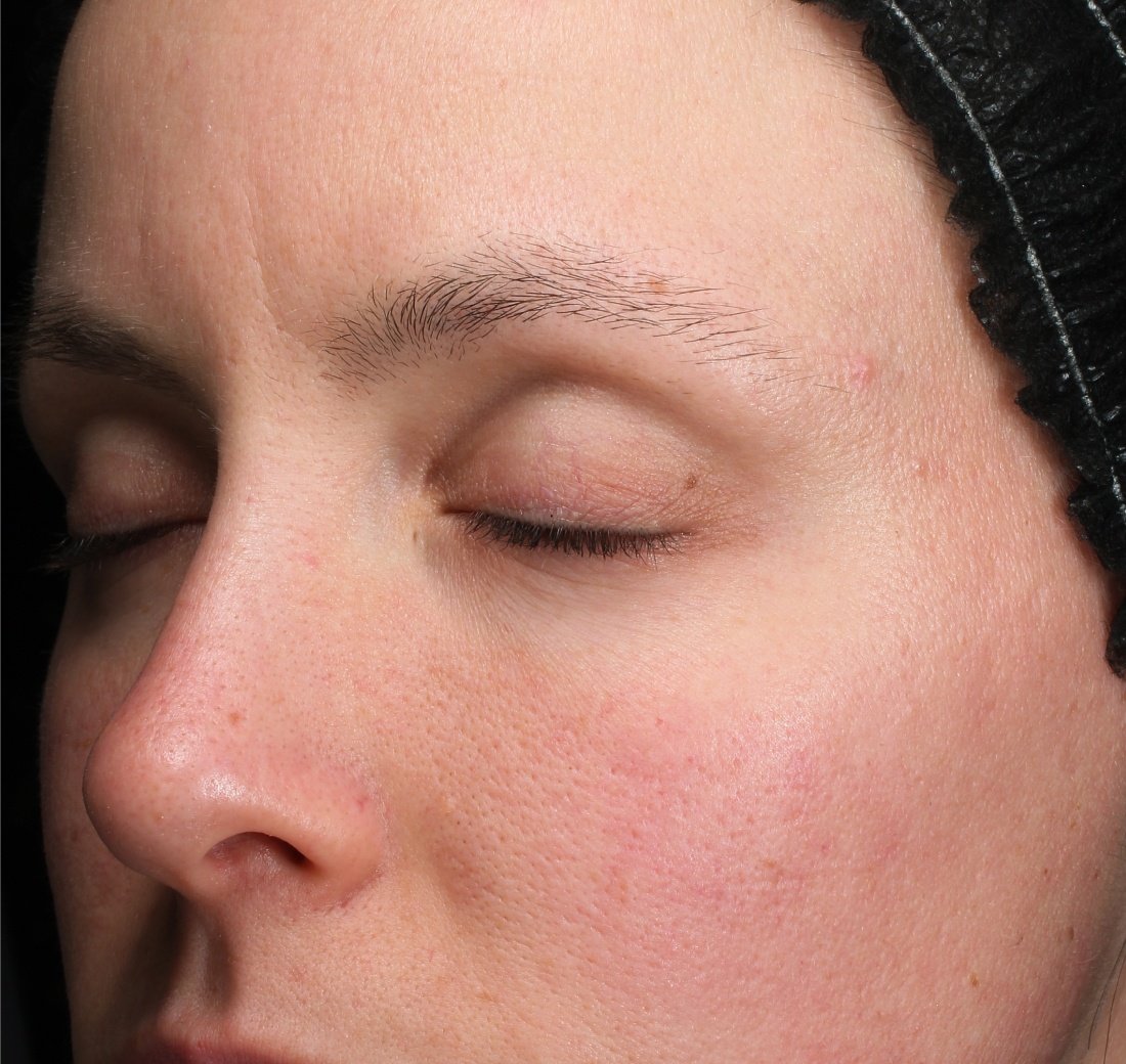 Baseline close-up of facial skin prior to using Obagi Retinol + PHA.