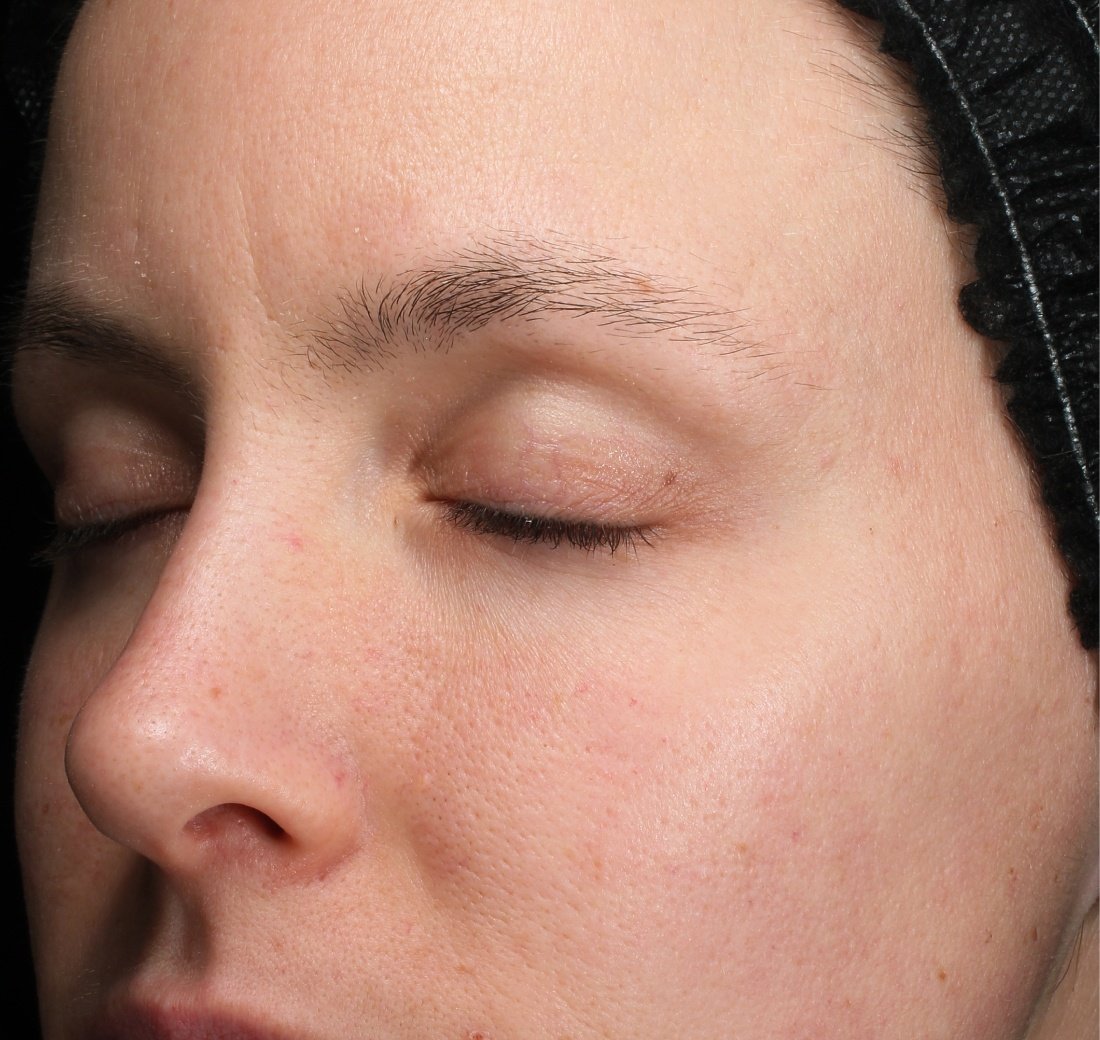 Close-up of facial skin after four weeks with Obagi Retinol + PHA application.