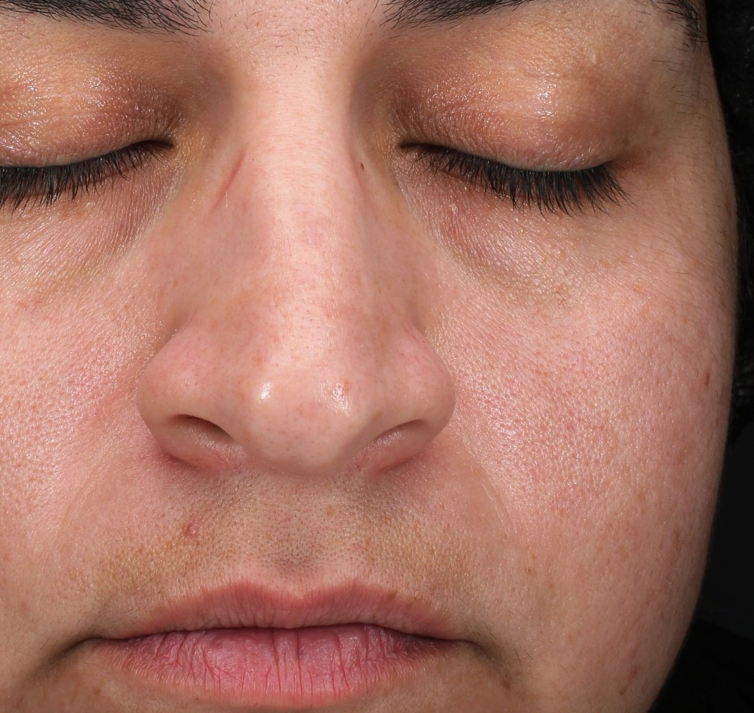 Baseline close-up of facial skin before Obagi Retinol + PHA application.