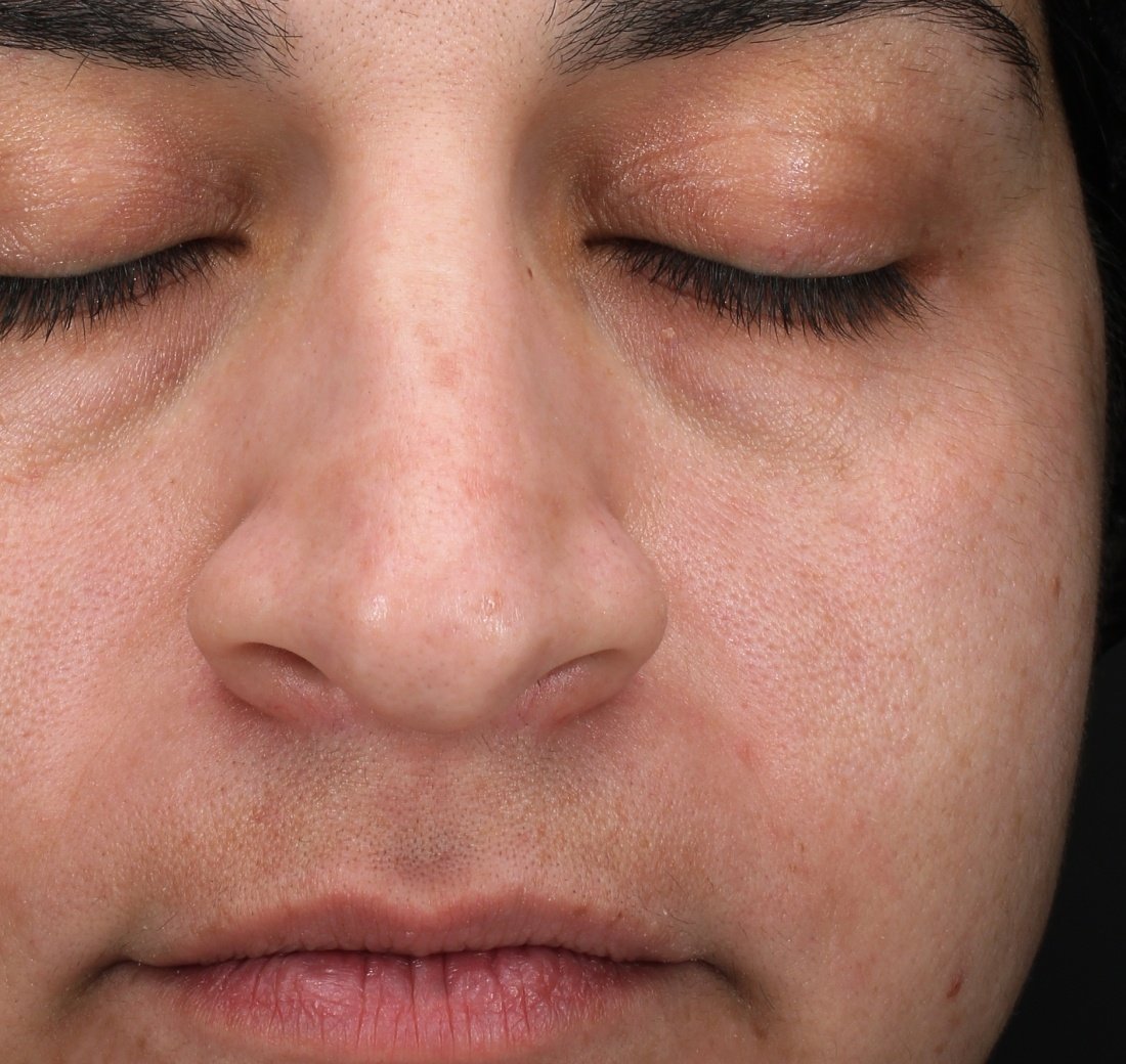 Close-up of facial skin after four weeks of Obagi Retinol + PHA treatment.